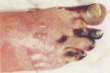 Gangrenous foot