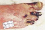 Gangrenous foot